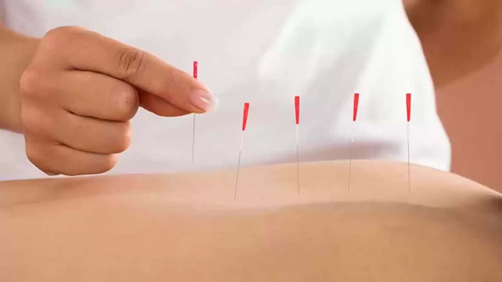 acupuntura